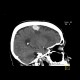 Hemorrhage in brain metastasis, perifocal edema: CT - Computed tomography